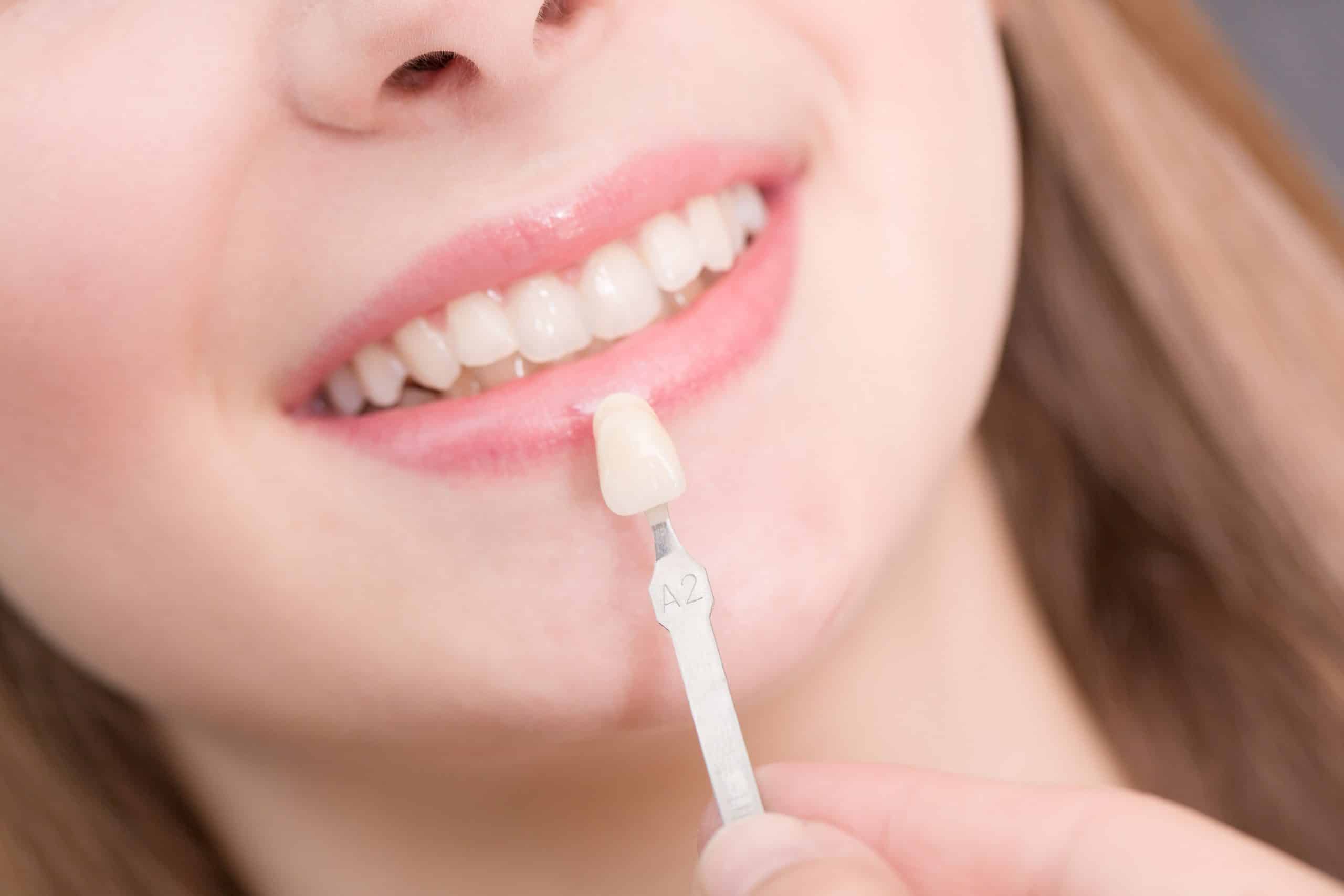 Your Guide to Getting Dental Veneers: What to Expect at Flintridge Dental Studio Introduction