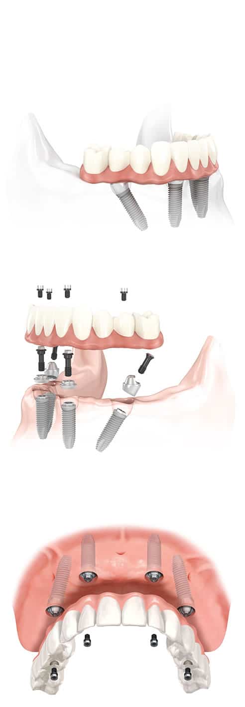 all on 4 dental implant diagram