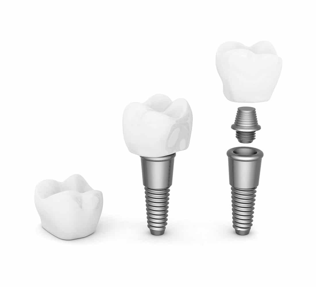 Home Implant Placement